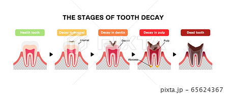 虫歯の進行と症状 イラスト 英語 のイラスト素材