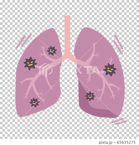 ウイルスによって肺炎になっている肺のイラスト。 65635275