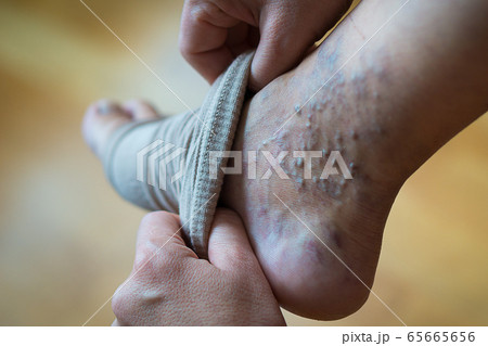 a woman puts a compression stocking on her leg - Stock Photo