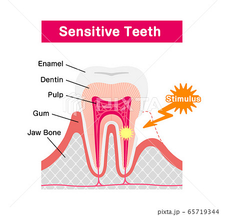 歯の知覚過敏 原因と仕組み 断面図ベクターイラスト 英語のイラスト素材