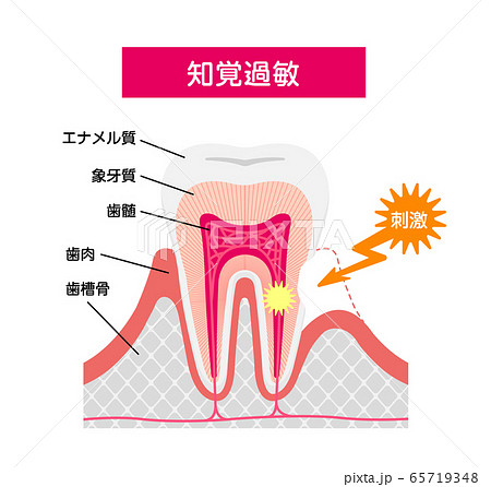 歯の知覚過敏 原因と仕組み 断面図ベクターイラスト のイラスト素材