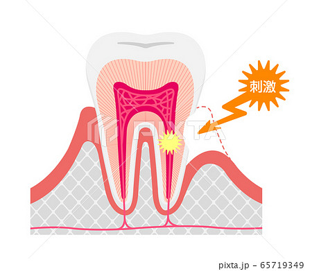 歯の知覚過敏　原因と仕組み 断面図ベクターイラスト 65719349