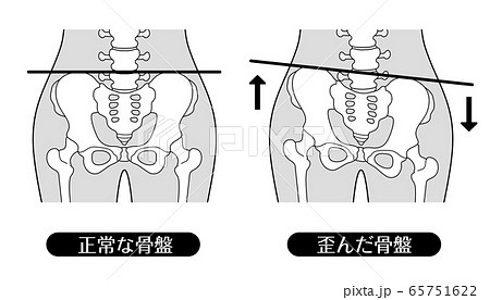 正常な骨盤と歪んだ骨盤 モノクロのイラスト素材