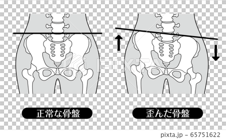 正常な骨盤と歪んだ骨盤 モノクロ 正常な骨盤と歪んだ骨盤 モノクロ 65751622