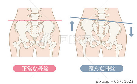 正常な骨盤と歪んだ骨盤のイラスト素材