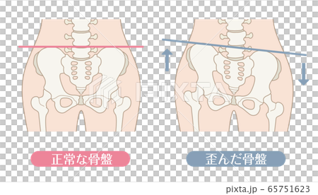 Normal pelvis and distorted pelvis 65751623