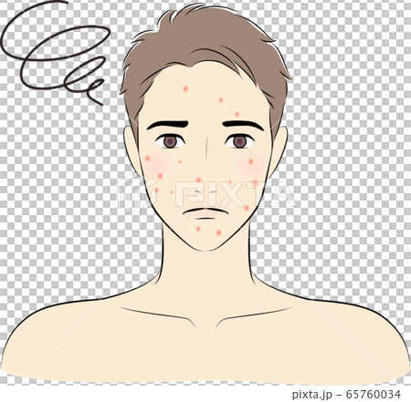 Men acne beauty 65760034