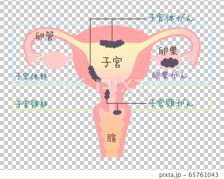 子宮がん・卵巣がんのイラスト・図説（文字あり） 65761043