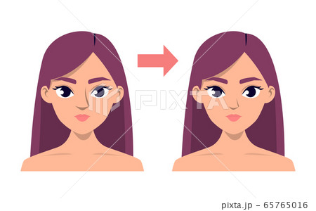 Rhihoplasty before and after. Nose shape Rhihoplasty before and after. Nose shape 65765016