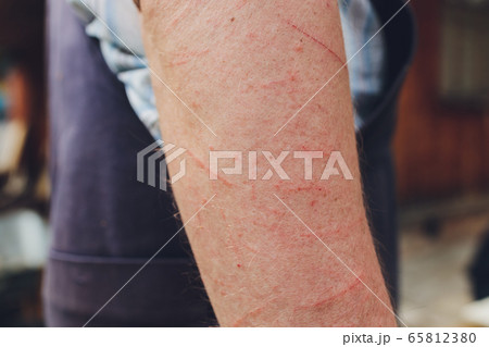 Skin allergy diseases problem, Poison tree contact dermatitis rash by pant, Female dermatology patient with allergic eczema on arm. Skin allergy diseases problem, Poison tree contact dermatitis rash by pant, Female dermatology patient with allergic eczema on arm. 65812380