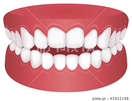 歯並び 歯列 不正咬合の種類 ベクターイラスト 開咬のイラスト素材