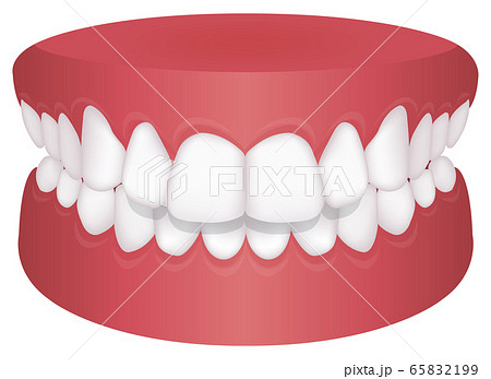 歯並び・歯列・不正咬合の種類 ベクターイラスト / 上顎前突（出っ歯） 65832199