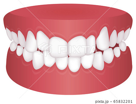 歯並び 歯列 不正咬合の種類 ベクターイラスト 叢生 乱杭歯 のイラスト素材 6521