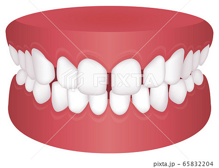 歯並び 歯列 不正咬合の種類 ベクターイラスト 空隙歯列 すきっ歯 のイラスト素材 6524