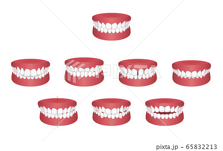 歯並び・歯列・不正咬合の種類 ベクターイラストセット（文字なし） 65832213