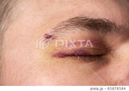 close view of a bruise near the eye, the face of a 65876584