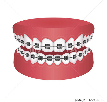 歯列矯正 歯の矯正 ベクターイラスト 矯正器具を装着のイラスト素材