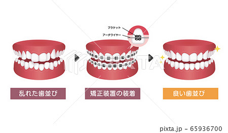 歯列矯正・歯の矯正のプロセス ベクターイラスト 歯列矯正・歯の矯正のプロセス ベクターイラスト 65936700