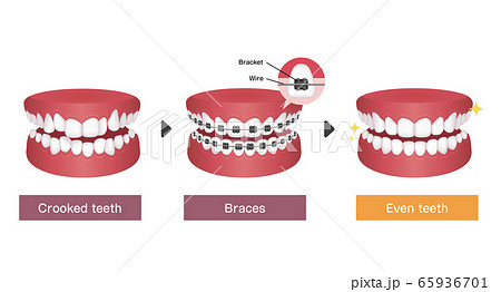 歯列矯正 歯の矯正のプロセス ベクターイラスト 英語のイラスト素材