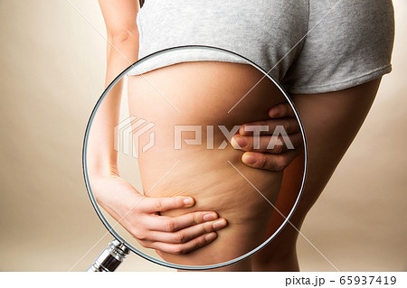 女性の太もものセルライトをルーペで拡大する 65937419
