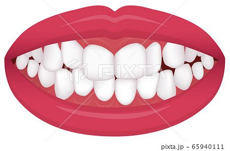 歯並び・歯列・不正咬合の種類 ベクターイラスト / 叢生（乱杭歯） 65940111