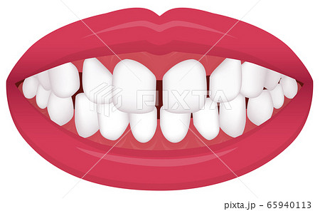 歯並び・歯列・不正咬合の種類 ベクターイラスト / 空隙歯列(すきっ歯) 歯並び・歯列・不正咬合の種類 ベクターイラスト / 空隙歯列(すきっ歯) 65940113