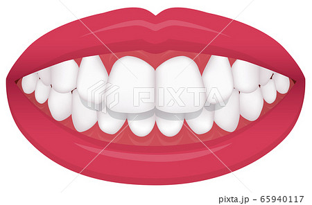 歯並び 歯列 不正咬合の種類 ベクターイラスト 上顎前突 出っ歯 のイラスト素材