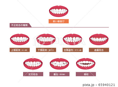 歯並び 歯列 不正咬合の種類 ベクターイラストセットのイラスト素材