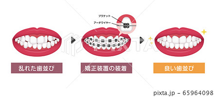 歯列矯正・歯の矯正のプロセス　ベクターイラスト 65964098