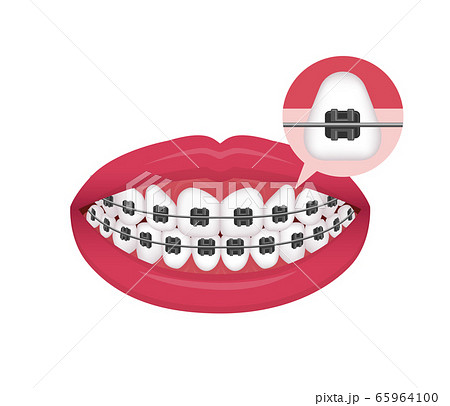 歯列矯正 歯の矯正 ベクターイラスト 矯正器具を装着のイラスト素材