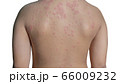 Urticaria or hives on child back with clipping 66009232