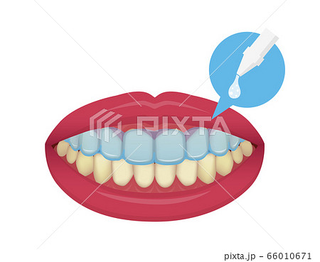 歯のホワイトニング（ホームホワイトニング）/ ホワイトニング施術 66010671