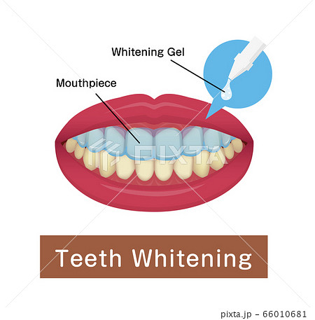 歯のホワイトニング ホームホワイトニング ベクターイラスト 英語のイラスト素材