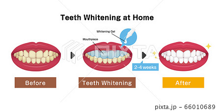 歯のホワイトニング（ホームホワイトニング）のながれ　ベクターイラスト / 英語 66010689