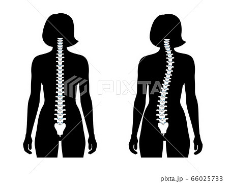 Scoliosis flat vector illustration Scoliosis flat vector illustration 66025733