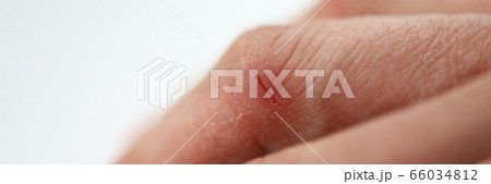 Damaged finger skin 66034812