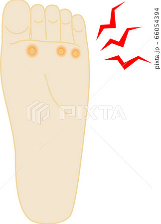 魚の目　痛い　足のイラスト 66054394