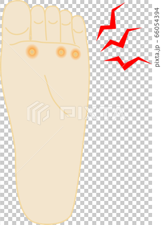 魚の目　痛い　足のイラスト 66054394