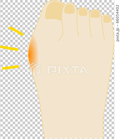Hallux valgus painful foot illustration 66054402