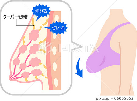 Woman Breast Cutaway Diagram. Stock Illustration - Illustration of