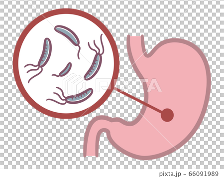 插圖顯示幽門螺桿菌潛伏在胃中 66091989