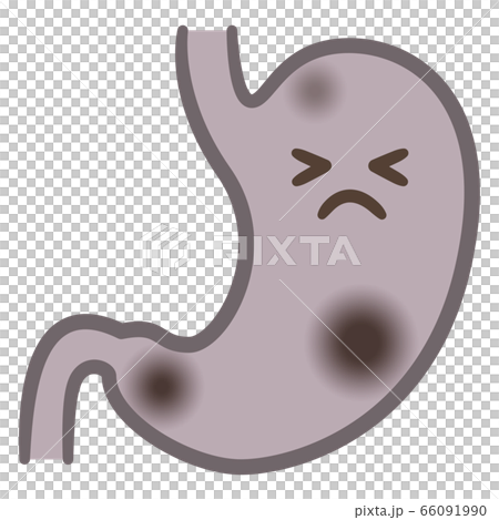 患有胃癌的胃的插圖 66091990