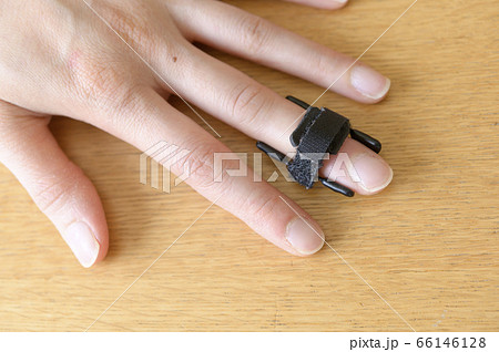 マレット変形の治療（バネ式固定装具） 66146128