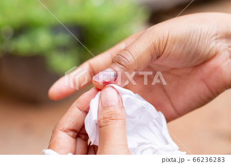 Injury to the right hand nail and bleeding to the 66236283