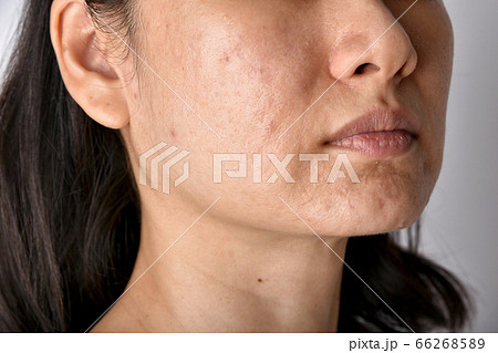 Skin problem with acne diseases, Close up of asian woman face with whitehead pimples Skin problem with acne diseases, Close up of asian woman face with whitehead pimples 66268589