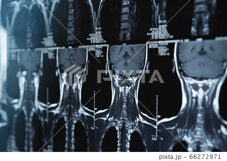 cervical spine x-ray film cervical spine x-ray film 66272971