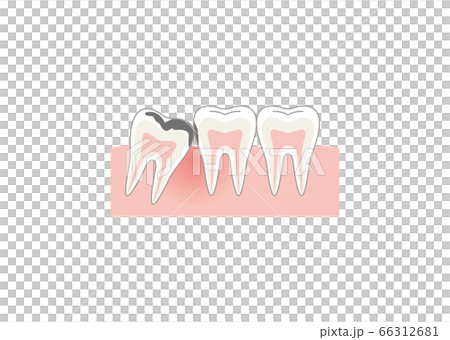 歯 66312681