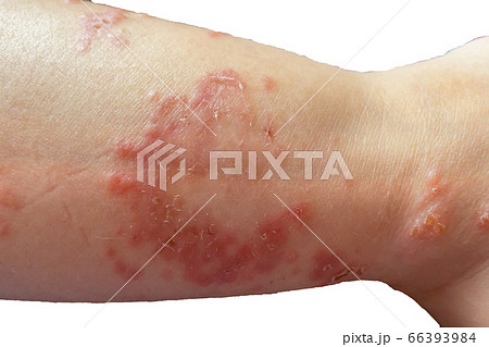 湿疹 手足口病 赤ちゃん １歳 足首 横の写真素材