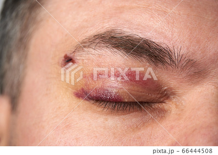close view of a bruise near the eye, the face of a 66444508