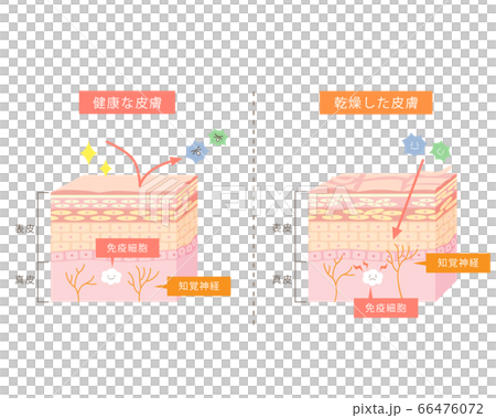 アトピー性皮膚炎 乾燥肌 の皮膚図解イラストのイラスト素材